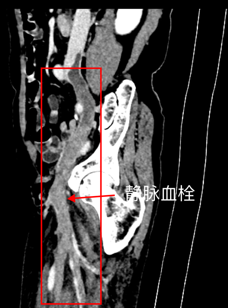 术前CT增强扫描